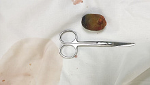 Врачи ККБ № 2 удалили пациентке огромный желчный камень малоинвазивным методом