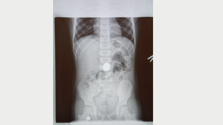 В Краснодарском крае врачи вытащили из желудка ребенка пятирублевую монету
