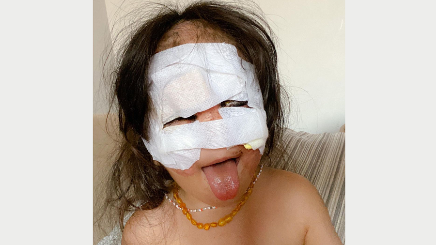 Мама девочки с «маской Бэтмена» показала лицо дочери после последней операции в Краснодаре
