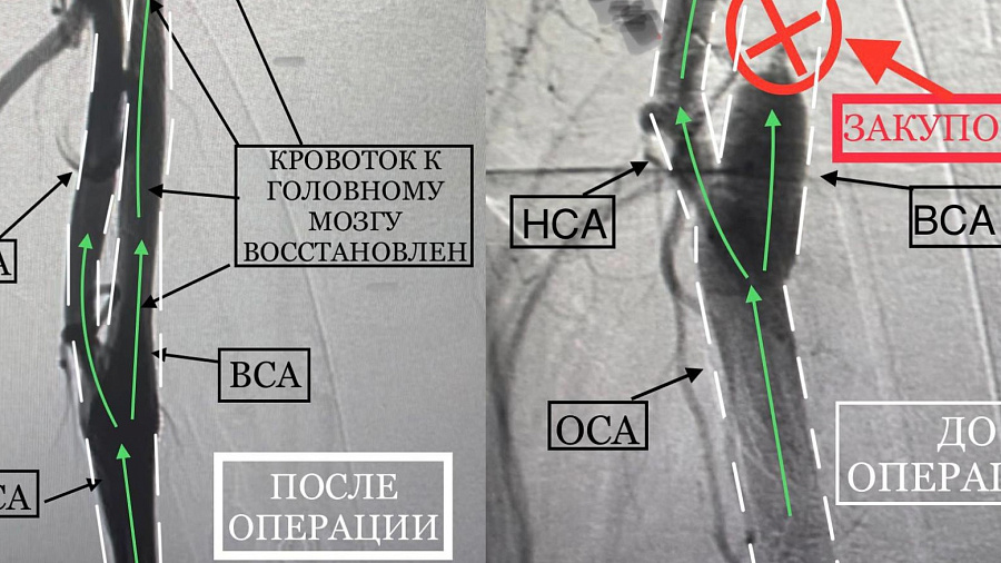 В Новороссийске хирурги впервые провели операцию на сонной артерии без единого разреза