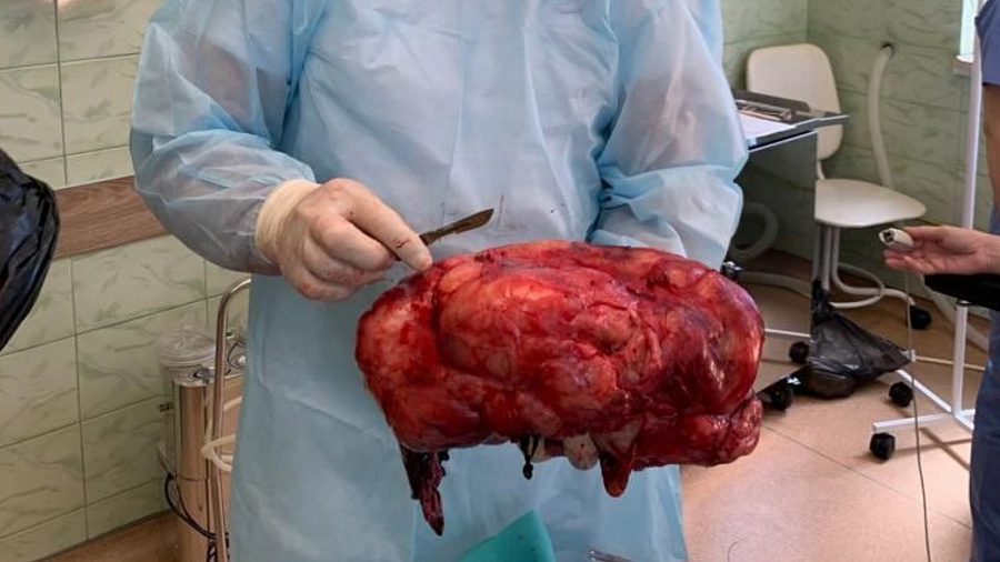 В Сочи хирурги удалили у пациента 6-килограммовую опухоль