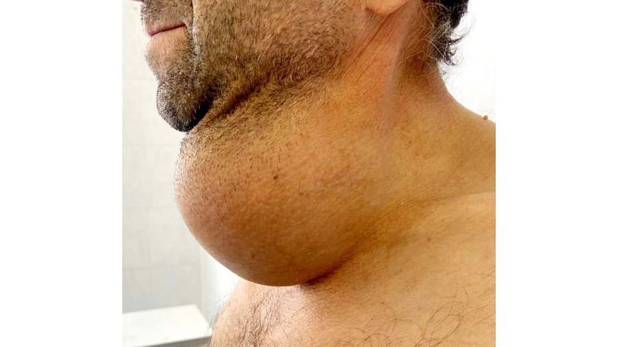 В Краснодаре врачи спасли мужчину с огромной опухолью в виде шара на шее