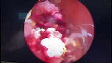В Краснодаре врачи без разрезов удалили у пациента огромную опухоль мочевого пузыря