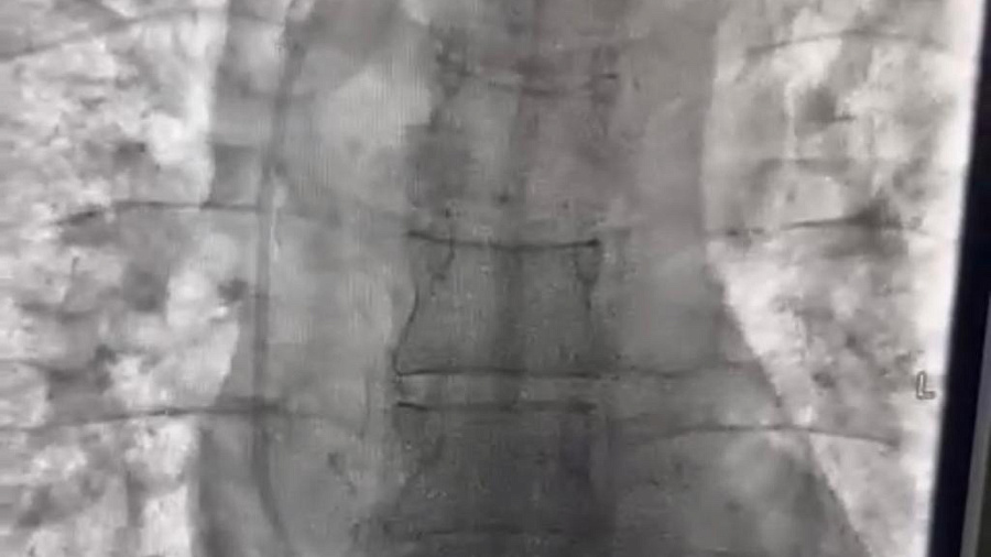 Новороссийские хирурги вытащили из сердца женщины 20-сантиметровый катетер