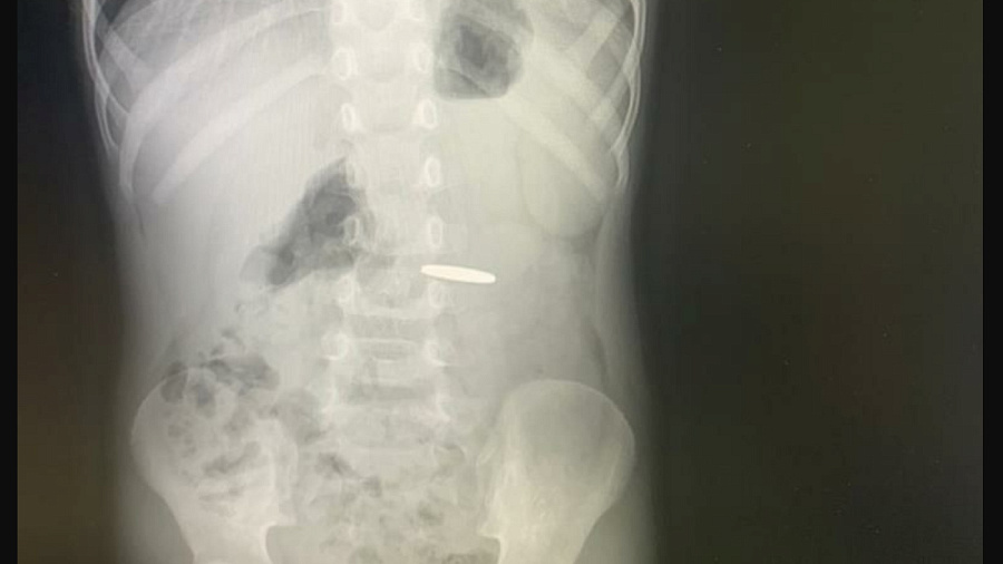 В Туапсе 3-летний малыш четыре дня проходил с монетой в желудке