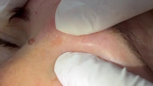 Краснодарский хирург удалил из глаза пациентки червя-паразита